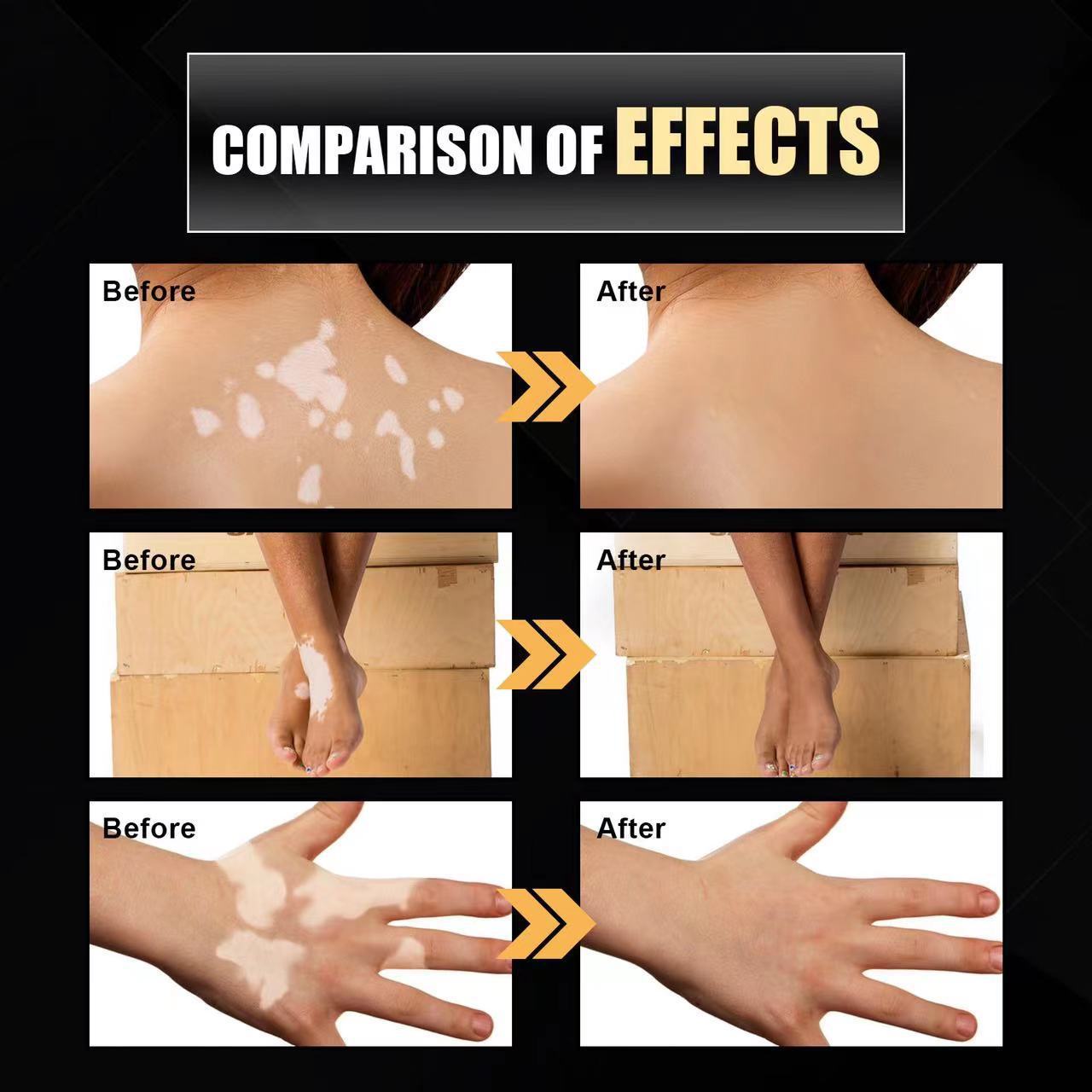 Moisturizing And Lightening White Spots, Flower Spots, Sweat Spots, Skin Care Spray