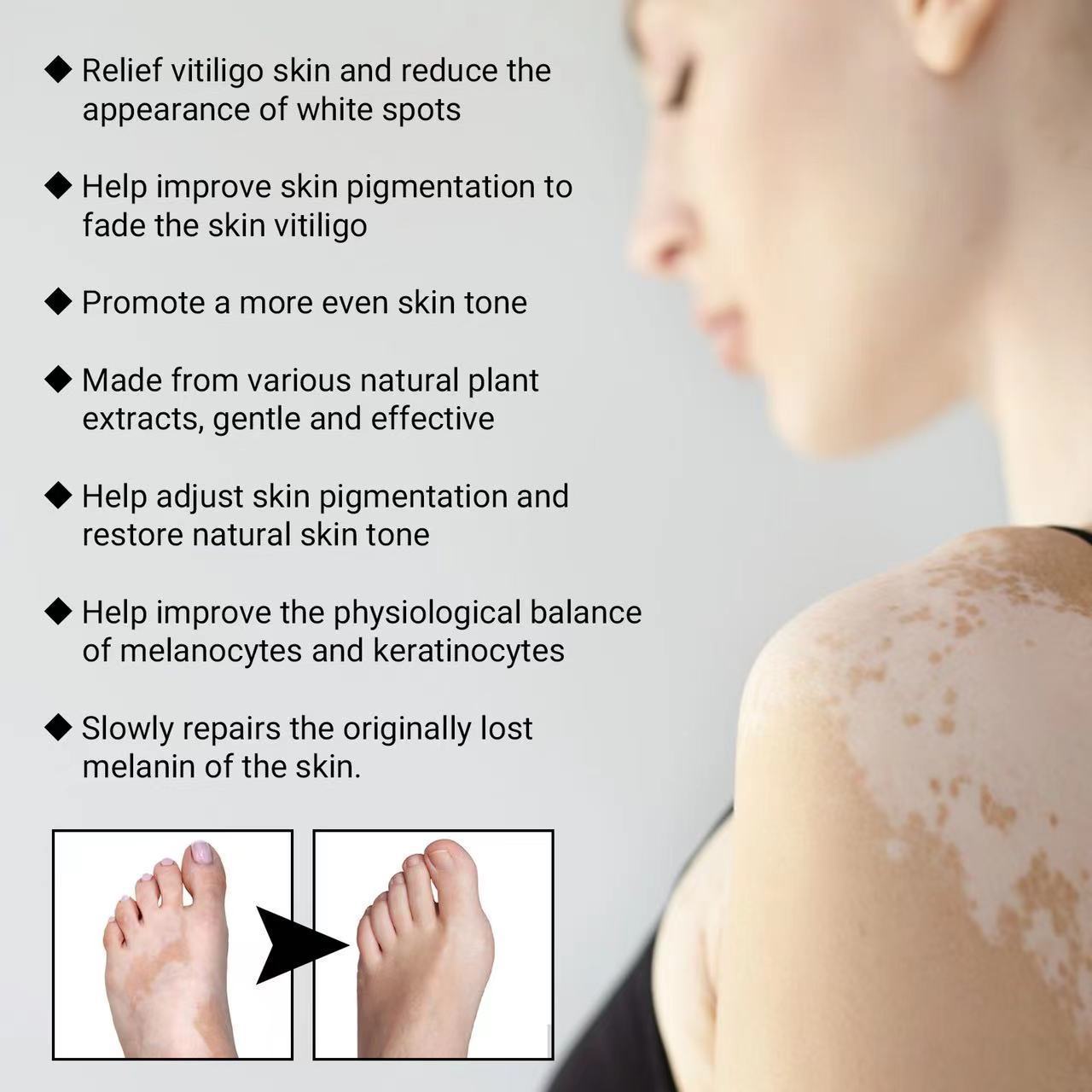 Moisturizing And Lightening White Spots, Flower Spots, Sweat Spots, Skin Care Spray